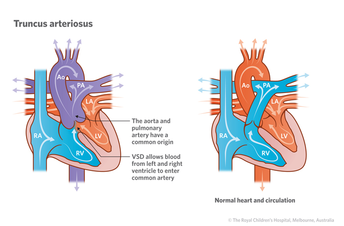 20a_Truncus_arteriosus