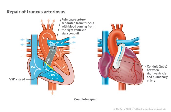 20b_Truncus_arteriosus