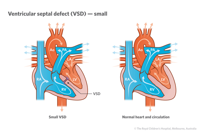 21a1_Ventricular_septal_defect_VSD