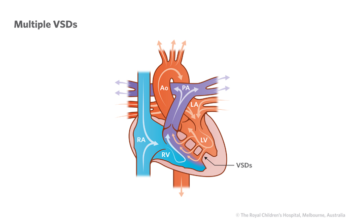 21a4_Ventricular_septal_defect_VSD