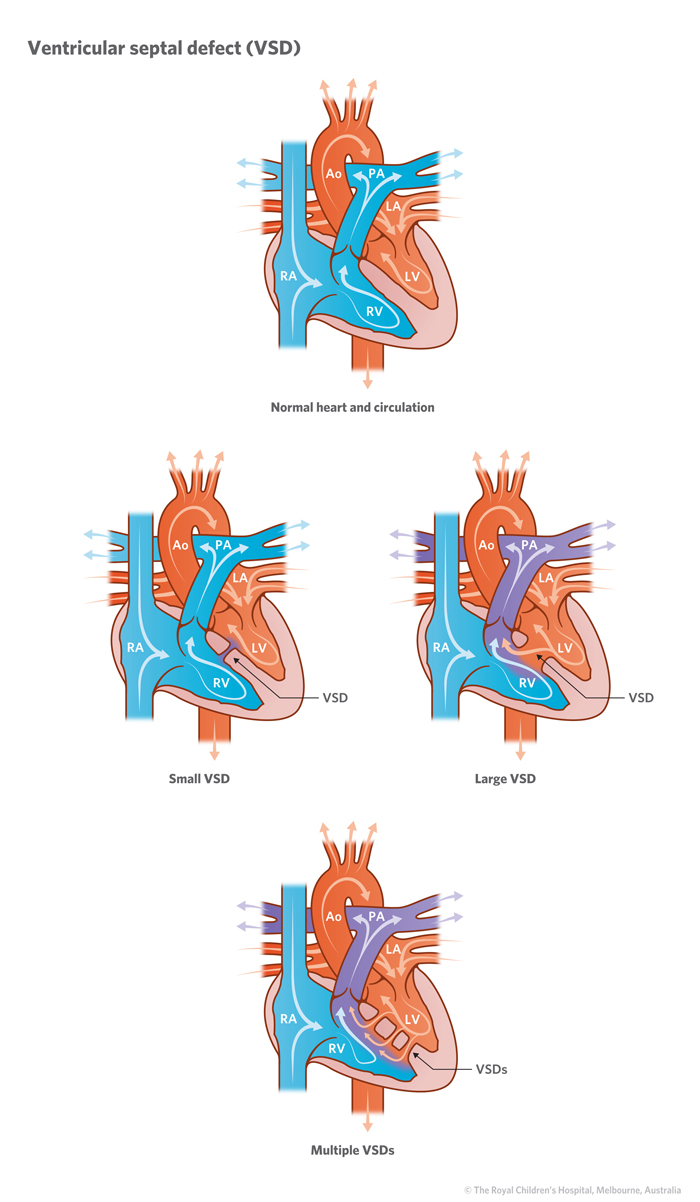 21a_Ventricular_septal defect_VSD