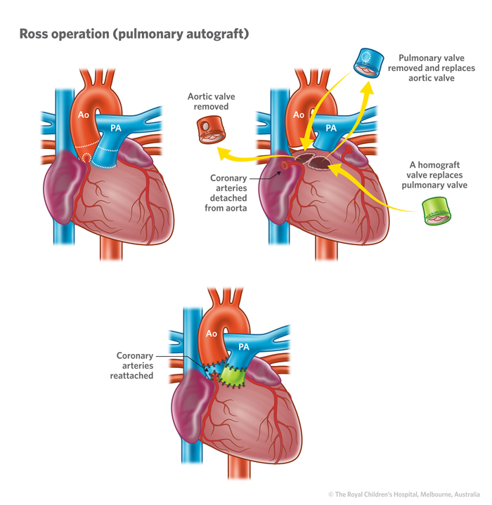 2d_Aortic_stenosis_AS