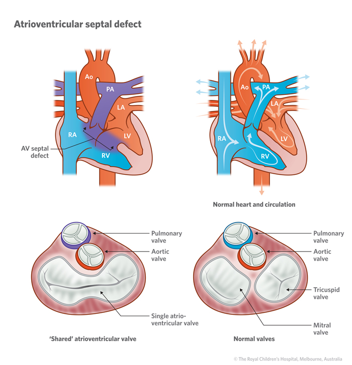 4a_Atrioventricular_septal_defect_AV_Canal_defect