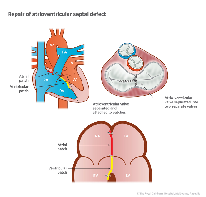 4b_Atrioventricular_septal_defect_AV_Canal_defect