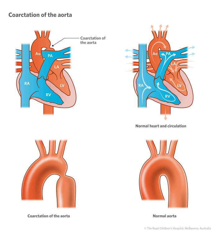 Coarctation of aorta