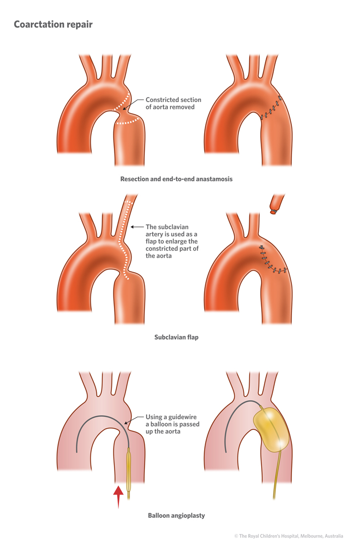5b_Coarctation_of_the_aorta 5b_Coarctation_of_the_aorta