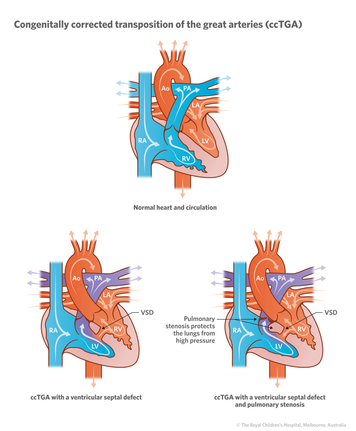 6a_Congenitally_corrected_TGA