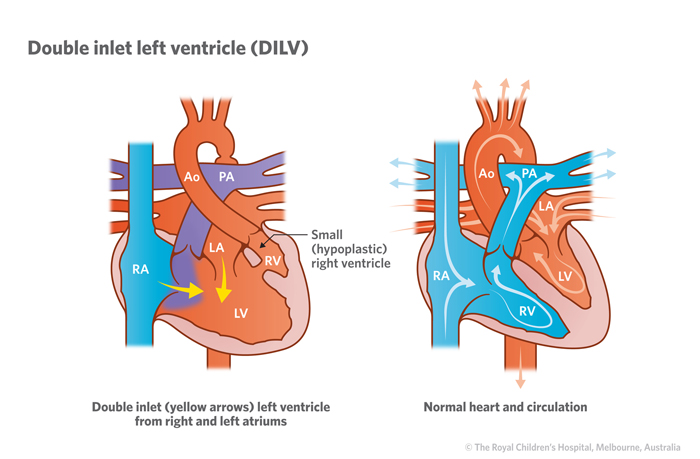7a_Double_inlet_left_ventricle_DILV