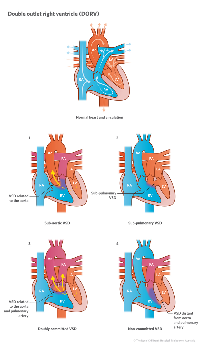 Cardiology : Double Outlet Right Ventricle