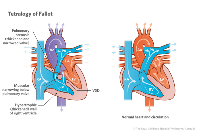 9a_Tetralogy_of_Fallot