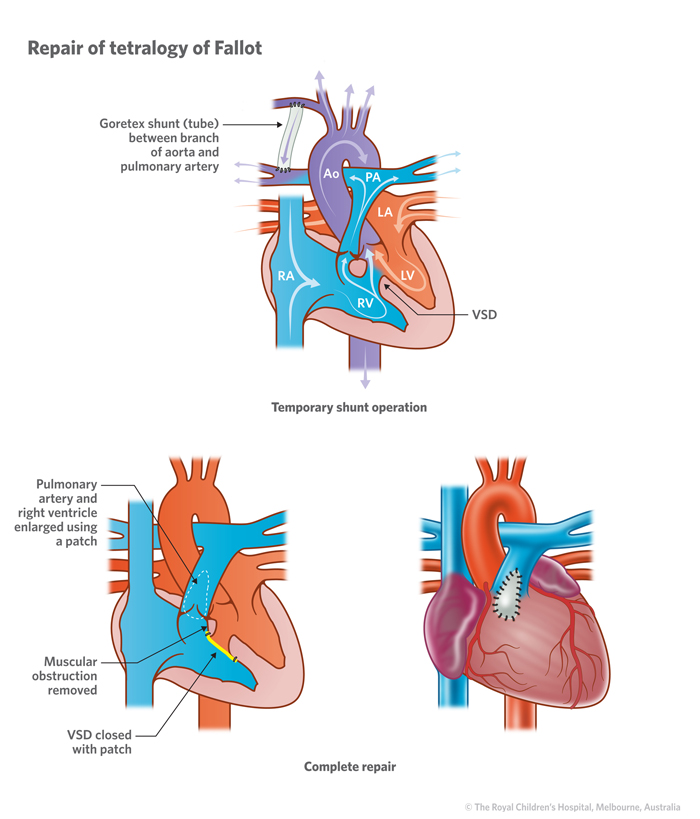 9b_Tetralogy_of_Fallot