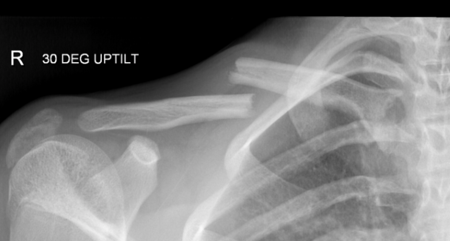 Clinical Practice Guidelines Clavicle Fractures Emergency Department