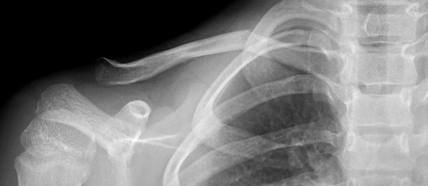 Fracture Clavicle