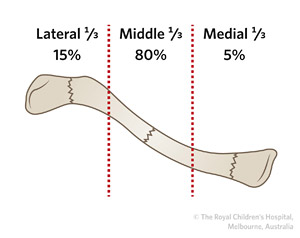 CLAVICLE-FRACTURE-CLASSIFICATION