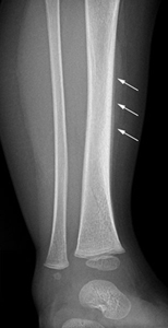 Spiral Fracture: Healing Time, Tibia, and Fibula