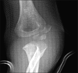 clinical practice guidelines lateral condyle fracture of the