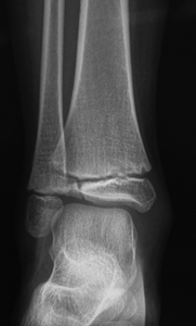 Clinical Practice Guidelines Distal Tibia And Or Fibula Physeal
