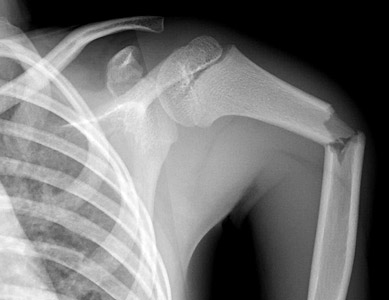 Clinical Practice Guidelines : Humeral shaft fractures - Emergency