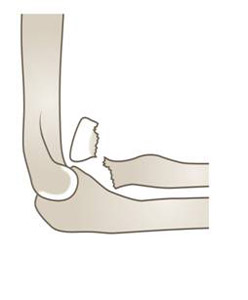 Figure-5_drawing_SH-II-radial-neck_Lat.jpg