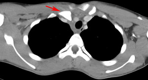 Clinical Practice Guidelines : Clavicle fractures - Emergency Department