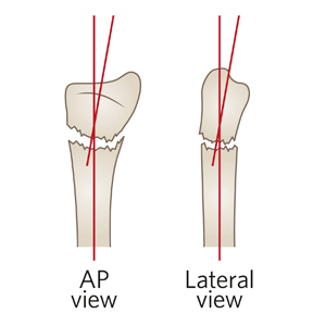 distalis radikális ulnar fájás)