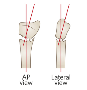 icd 10 code for fracture radius right