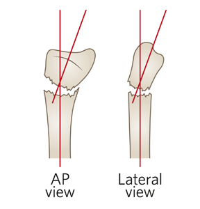 /uploadedImages/Main/Content/clinicalguide/Fracture-Distal-radial-metaphyseal-ED_Section-7_ACCEPTABLE-ANGULATION-20-degrees.jpg