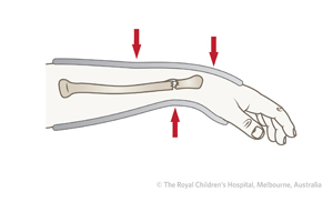 Fracture-Distal-radial-metaphyseal-ED_Section-9_THREE-POINT-MOULDING-dorsal-angulation.jpg