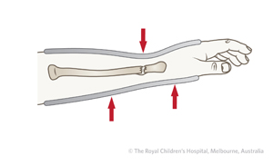 Fracture-Distal-radial-metaphyseal-ED_Section-9_THREE-POINT-MOULDING-volar-angulation.jpgction-9_THREE-POINT-MOULDING-dorsal-angulation.jpg