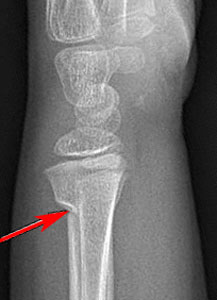 Fracture-Distal-radial-metaphyseal-Fig-1_1064317-new-buckle-fracture_lat.jpg