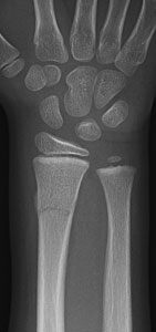 distal radius metaphyseal fracture radial buckle ulna displaced fractures metaphysis complete emergency department rch unstable year old cast minimally figure