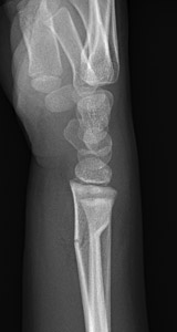 Fracture-Distal-radial-metaphyseal-Fig-2_1112344_complete-fracture-with-buckle_distal-radius_lateral.jpg_1112344_complete-fracture-with-buckle_distal-radius_AP.jpg