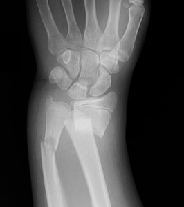 Fracture-Distal-radial-metaphyseal-Fig-3_1309340_complete-fracture_distal-radius_AP.jpg