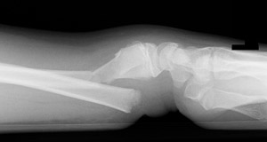 Fracture-Distal-radial-metaphyseal-Fig-3_1309340_complete-fracture_distal-radius_lateral.jpg