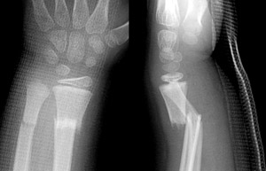 Fracture-Distal-radial-metaphyseal-Fig-4_1219783-Bayonet-apposition.jpg