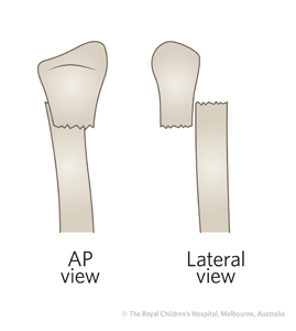 Fracture-Distal-radial-metaphyseal-Fig-4_Bayonet-radius_Drawing2.jpgal-Fig-4_1219783-Bayonet-apposition.jpg