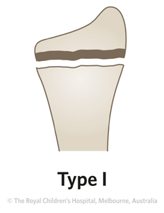 Fracture-Distal-radial-physeal-ED_Section-1-and-2_SALTER-HARRIS-RADIUS-1.jpg