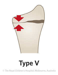 Fracture-Distal-radial-physeal-ED_Section1-and-2_-SALTER-HARRIS-RADIUS-5.jpg