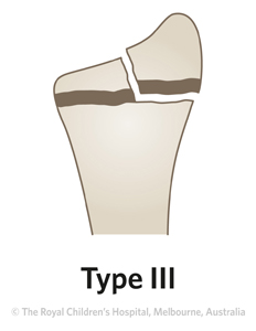 Fracture-Distal-radial-physeal-ED_Section1-and-2_SALTER-HARRIS-RADIUS-3.jpg