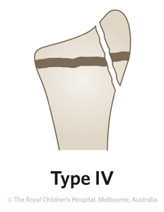 Fracture-Distal-radial-physeal-ED_Section1-and-2_SALTER-HARRIS-RADIUS-4.jpg