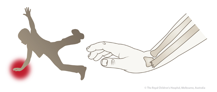 Fracture-Distal-radial-physeal-Figure-1_RADIAL-FRACTURE-AFTER-FALL.jpg