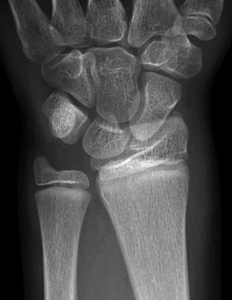 Fracture-Distal-radial-physeal-Figure-2_1396963-salter-harris1_AP.jpg