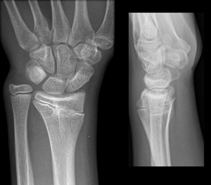 Fracture-Distal-radial-physeal-Figure-4_1186622_distal-radial-physeal_growth-arrest.jpg 