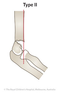 /uploadedImages/Main/Content/clinicalguide/Fracture-Supracondylar-ED_Section-1_GARTLAND-FRACTURE-T2-with-line.jpg