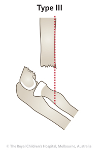 Fracture-Supracondylar-ED_Section-1_GARTLAND-FRACTURE-T3-with-line.jpg