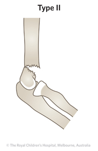 Fracture-Supracondylar-ED_Section-2-_Table-1_GARTLAND-FRACTURE-T2.jpg