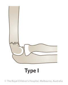 Fracture-Supracondylar-ED_Section-2_Table-1_GARTLAND-FRACTURE-T1.jpg