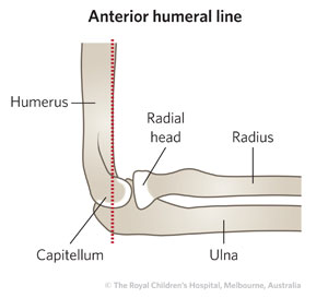 Fracture-Supracondylar-ED_Section-6_ANT-HUMERAL-LINE.jpg