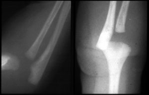 Fracture-Supracondylar-ED_Section-6_Box-SH-1-birth-injury-distal-humerus.jpg