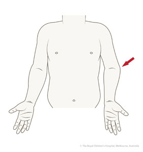 Fracture-Supracondylar-Figure-5_CUBITUS-VARUS.jpg